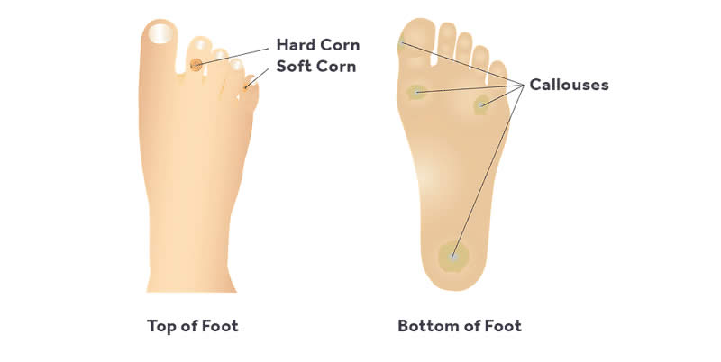 Callus/Corn Foot – Varah Healthcare Speciality Clinic